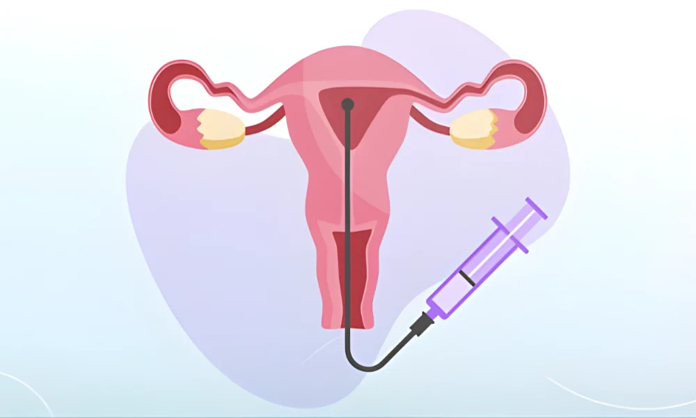 Best Intrauterine Insemination (IUI) Treatment in Secunderabad – Dr. Prodduturu Padmaja 
